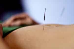 Acupuncture for PCOS