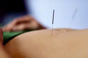 Acupuncture for PCOS