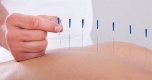 treatments - acupuncture for pcos