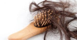 pcos and hair loss