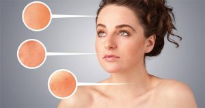 pcos symptoms - pcos and acne