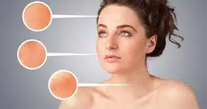 pcos symptoms - pcos and acne