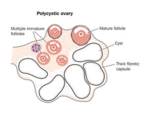 8 reasons your pcos diagnosis may be missed ovary
