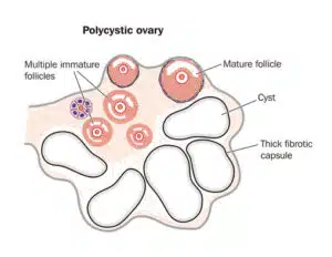 8 reasons your pcos diagnosis may be missed ovary