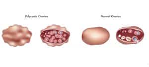 polycystic ovary