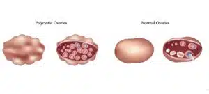 polycystic ovary