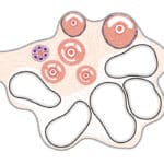 pcos-insulin-metformin