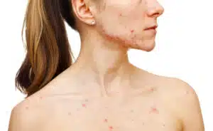 woman with pcos hormonal acne on her jawline and neck